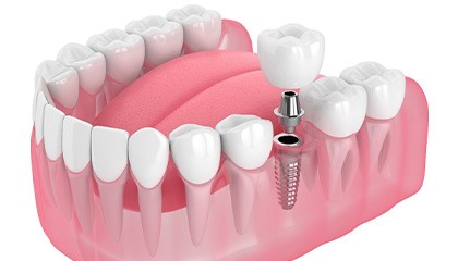 Illustration of a single dental implant