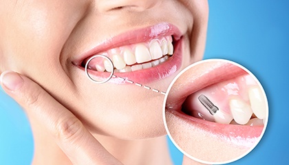 an illustration showing a patient’s smile with a dental implant