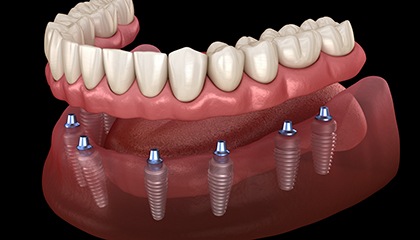 Illustration of lower arch of implant dentures with black background