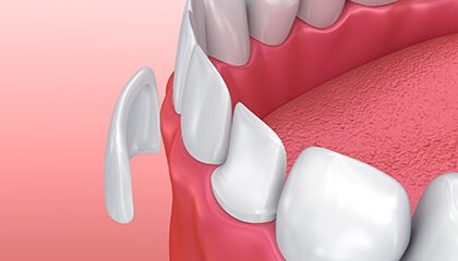 Animation of porcelain veneer placement