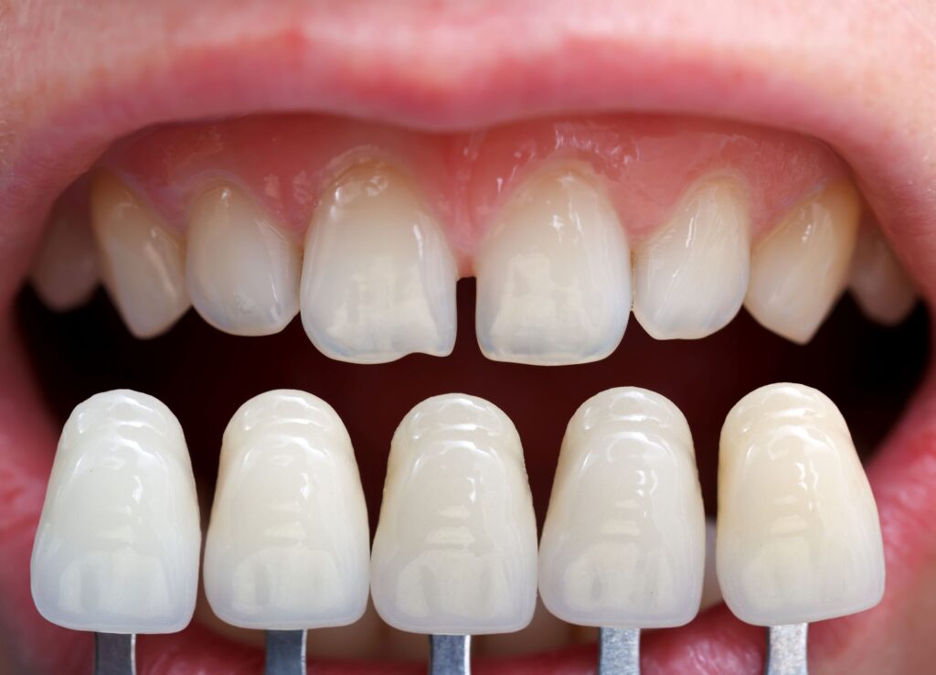 Closeup of a mouth full of misshapen teeth with veneers being held up